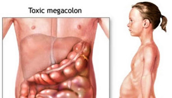 toxic megacolon