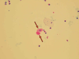 urine epithelial caudate