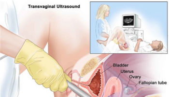 transvaginal ultrasound