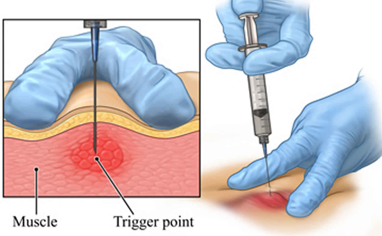 Trigger Point Injections Trigger Point Injection Technique Side Effects