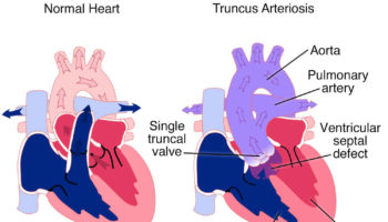 truncus arteriosus