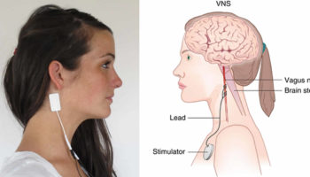 vagus nerve stimulation