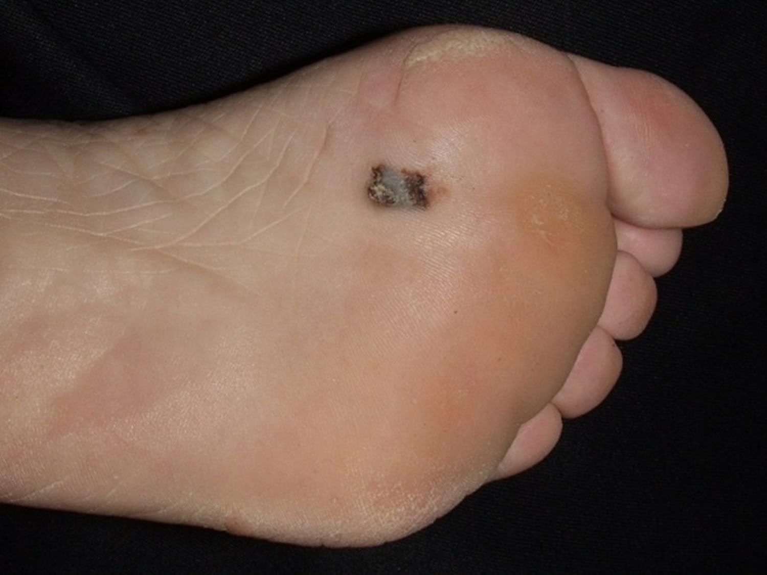 Acral lentiginous melanoma foot