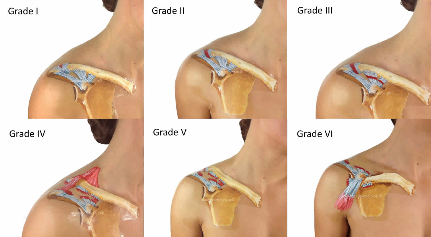 Acromioclavicular joint separation