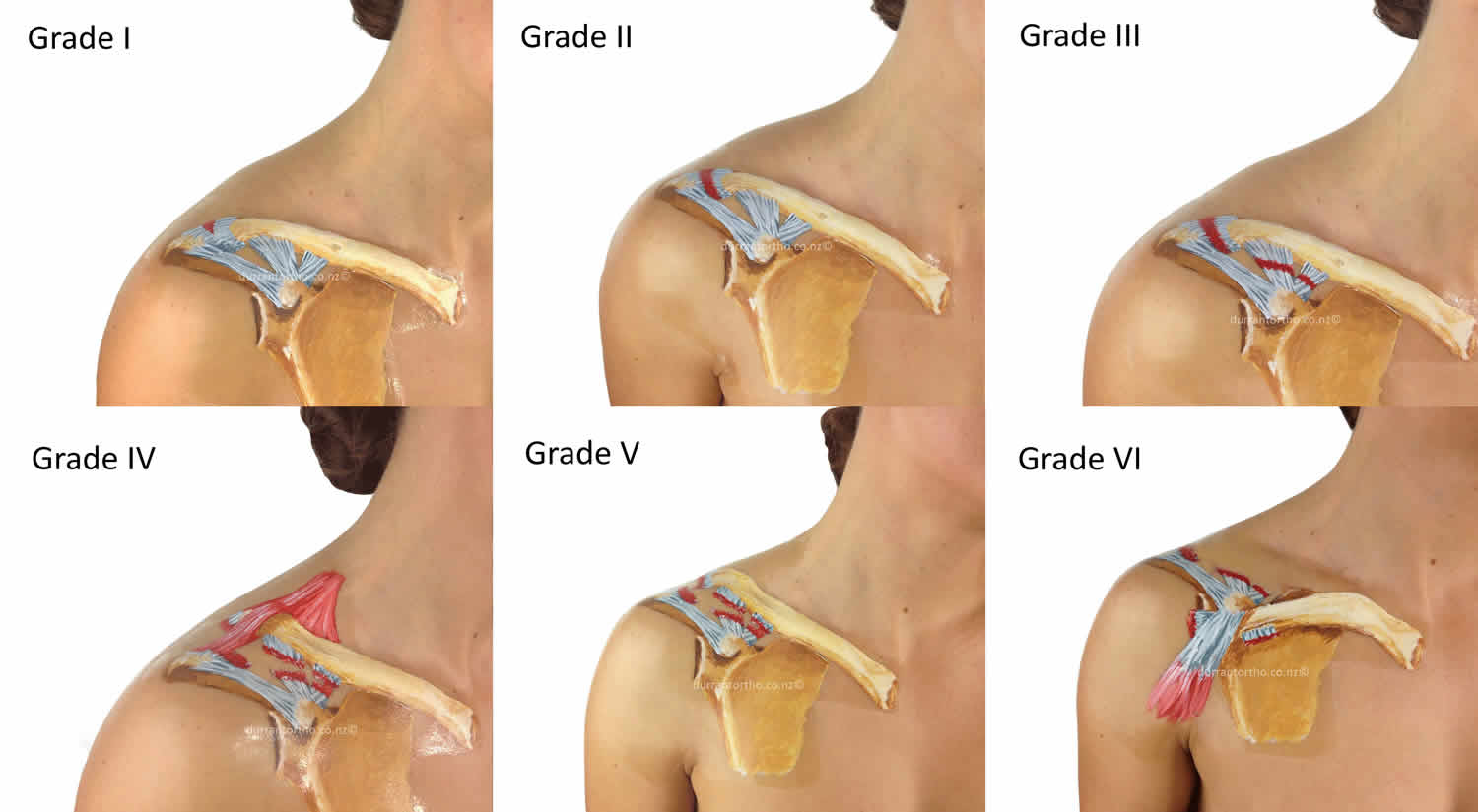 Acromioclavicular Joint Acromioclavicular Joint Injury Separation 