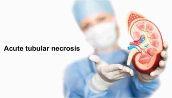 Acute tubular necrosis