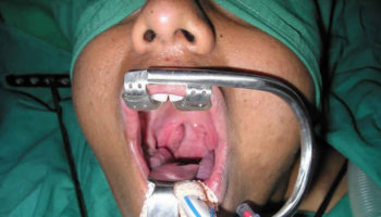 Adenoidectomy