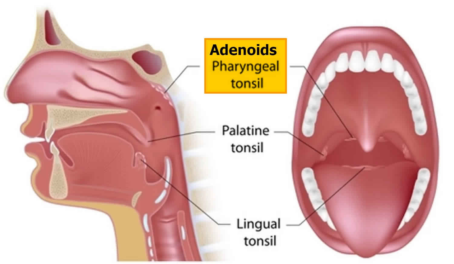 Adenoidectomy Tonsillectomy And Adenoidectomy Recovery Complications
