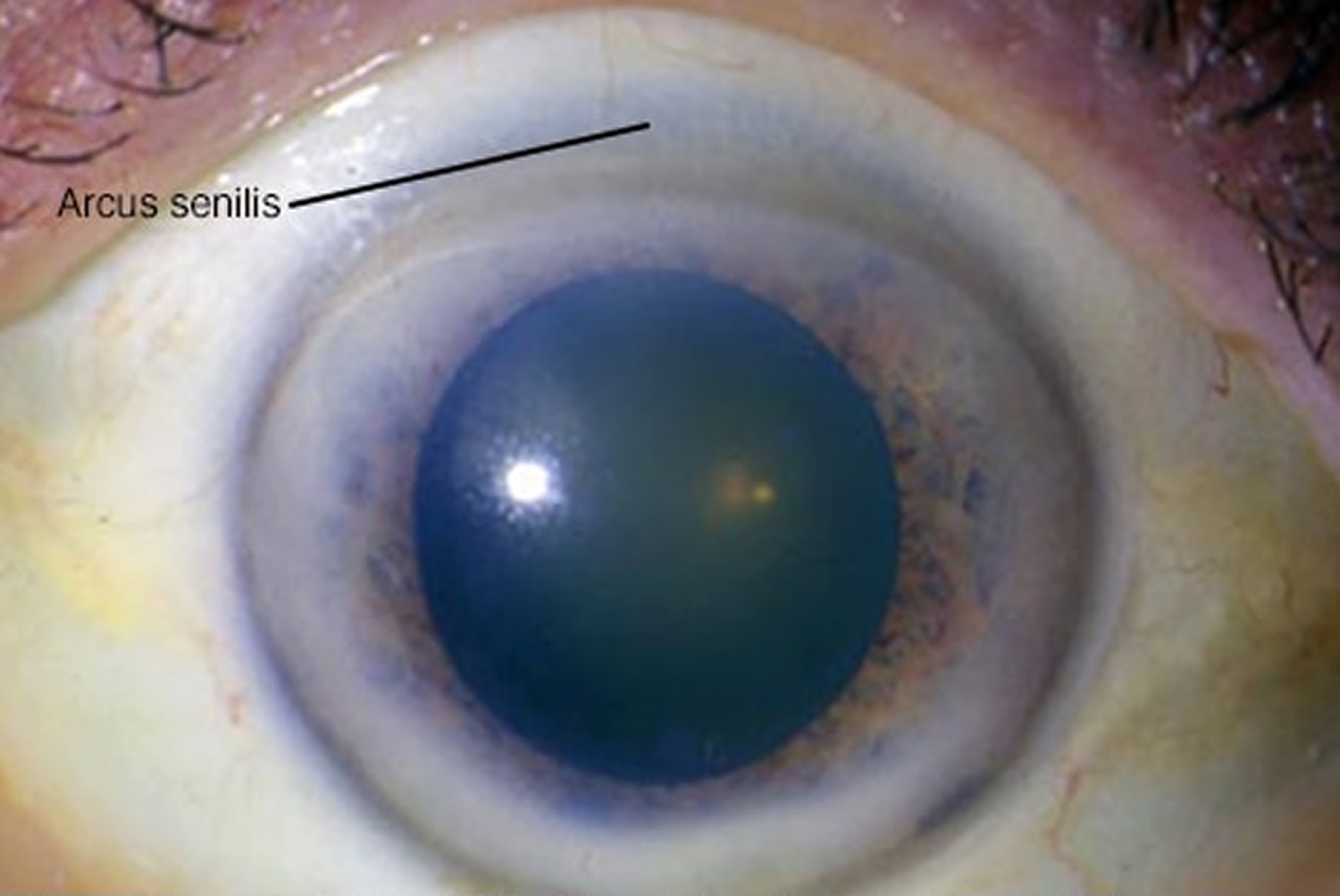 There is ring around my iris - fat deposits and lipid build up