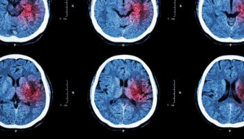 Brain hemorrhage