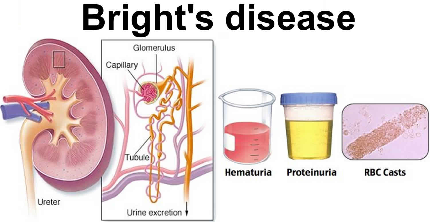 Bright's disease definition, causes, symptoms, diagnosis & treatment