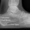 Calcaneal spur
