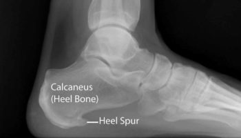 Calcaneal spur