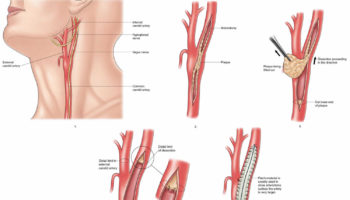 Carotid endarterectomy