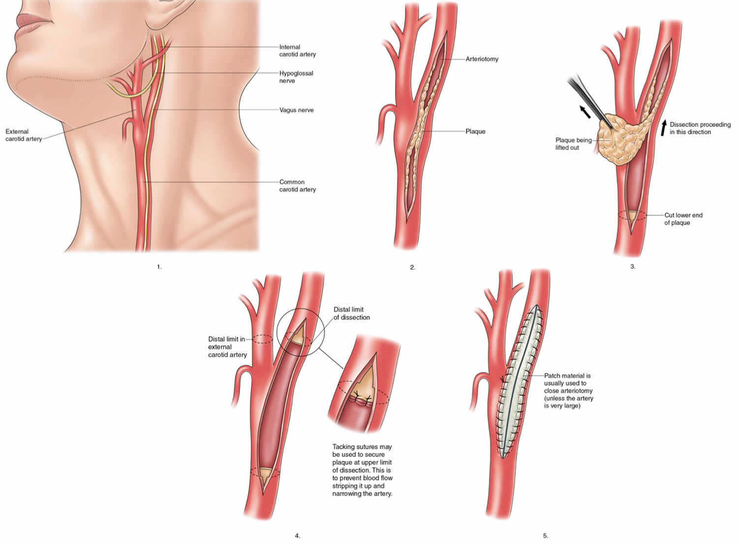 carotid-endarterectomy-indications-risks-complications-recovery