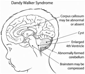 Dandy Walker syndrome causes, symptoms, diagnosis, treatment & prognosis