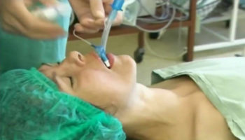 Endotracheal intubation