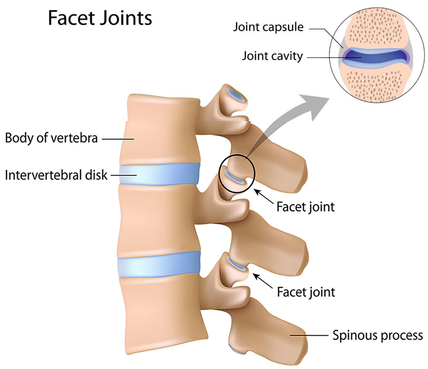 Facet arthropathy