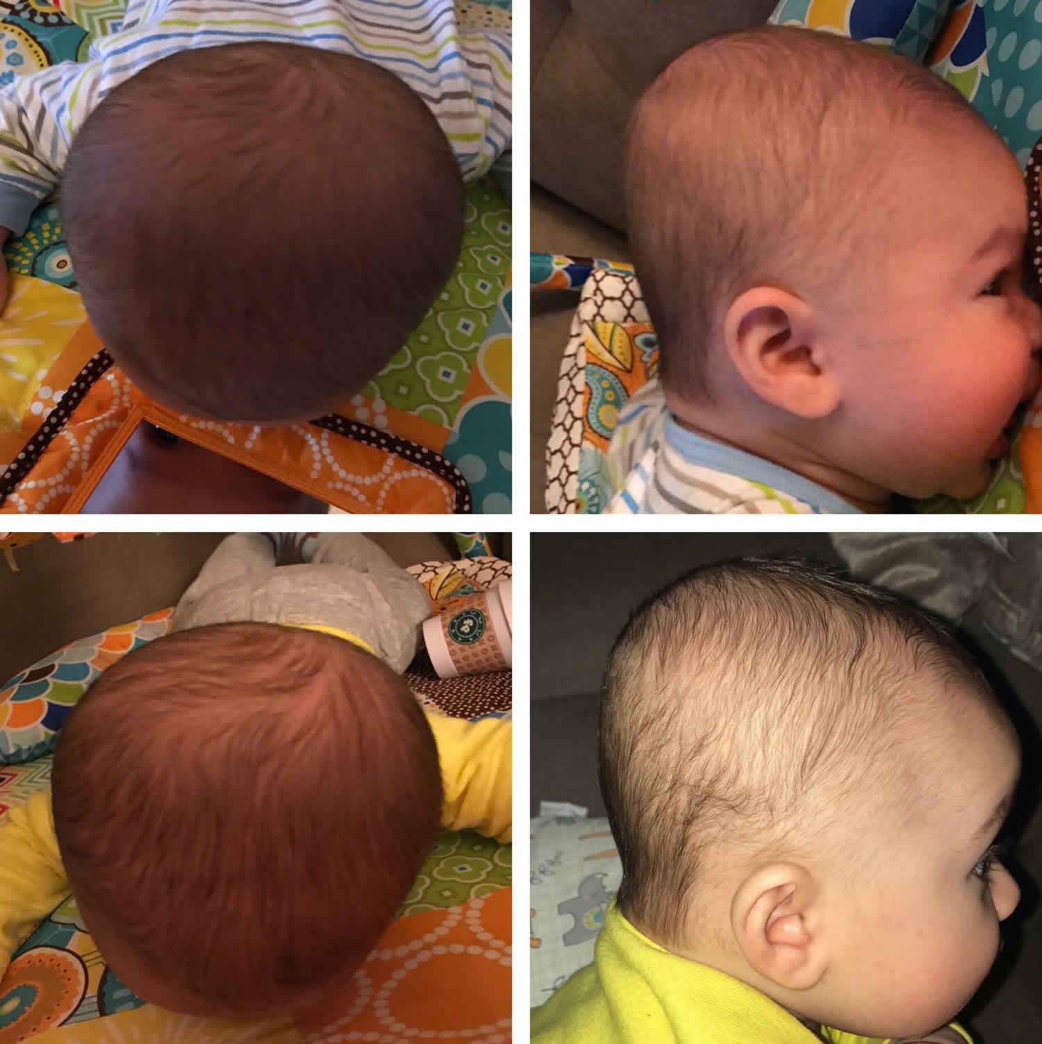 Severe flat head 2024 syndrome in babies