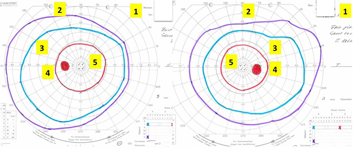 Visual Field Test Visual Field Test Results Interpretation