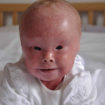 Harlequin ichthyosis