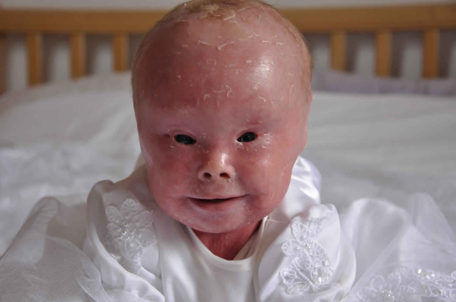 Harlequin ichthyosis causes, symptoms, diagnosis, survival ...