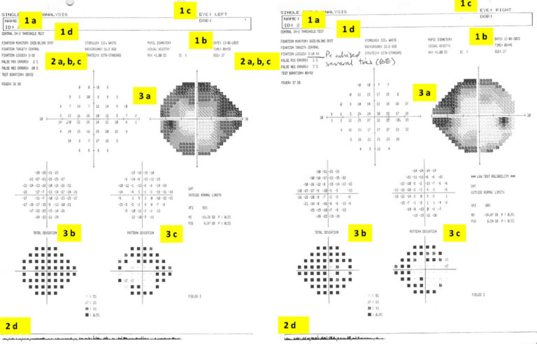 Visual field test, visual field test results interpretation