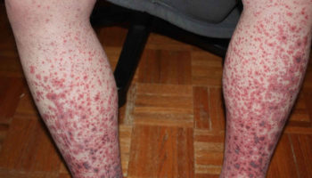 Idiopathic thrombocytopenic purpura