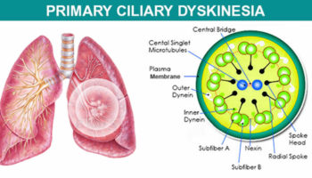 Kartagener syndrome