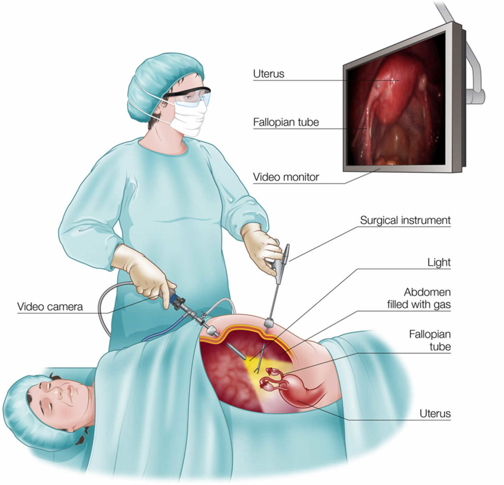 Laparotomy surgery, exploratory laparotomy or open laparotomy procedure