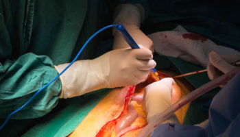 Laparotomy