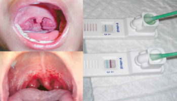 Rapid strep test