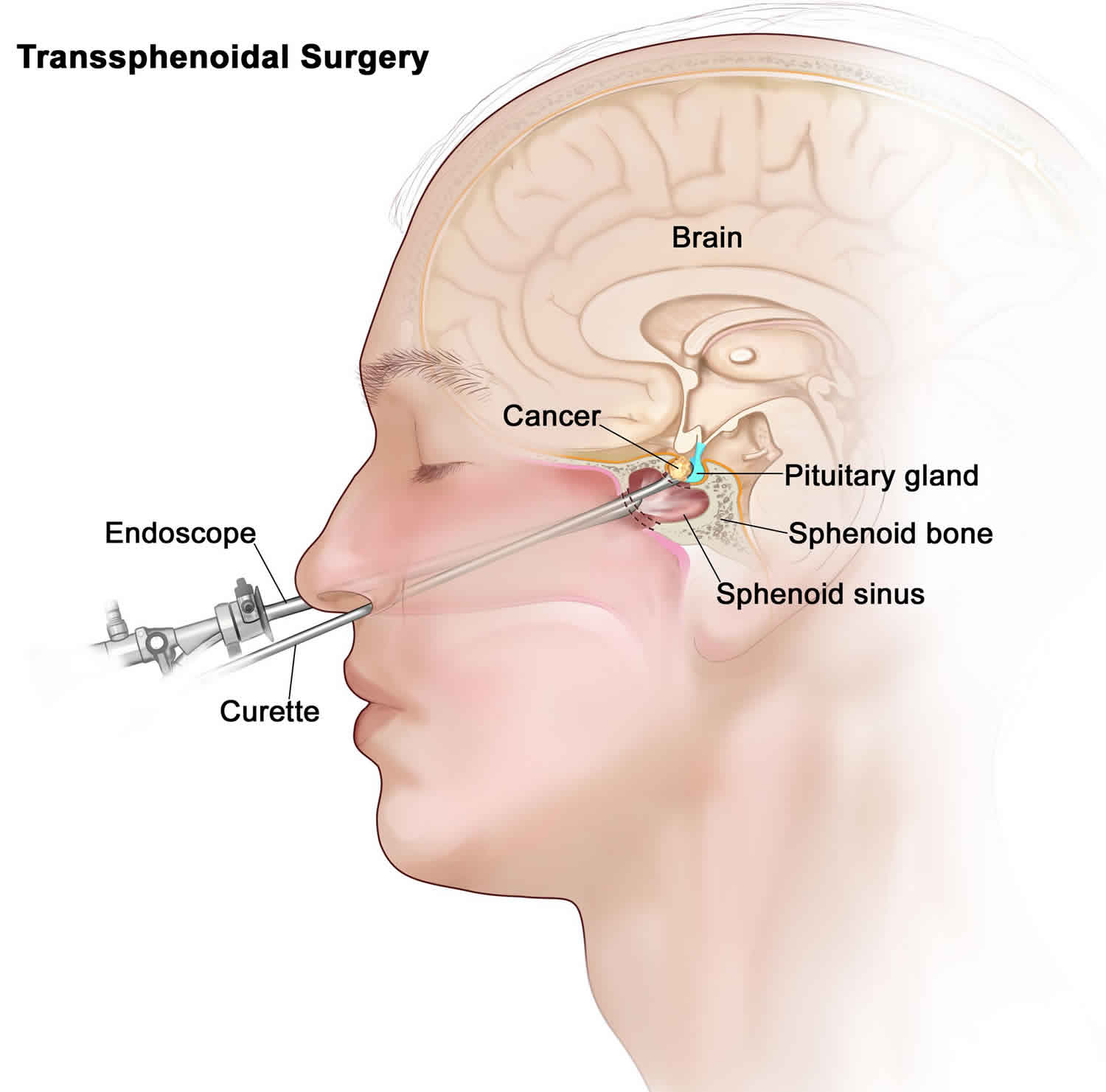 Pituitary adenoma causes, symptoms, diagnosis, treatment