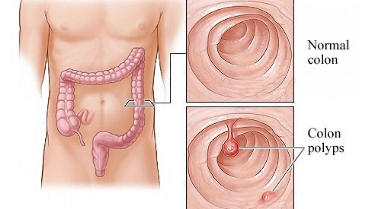 What Is High Grade Dysplasia In Colonic Adenoma