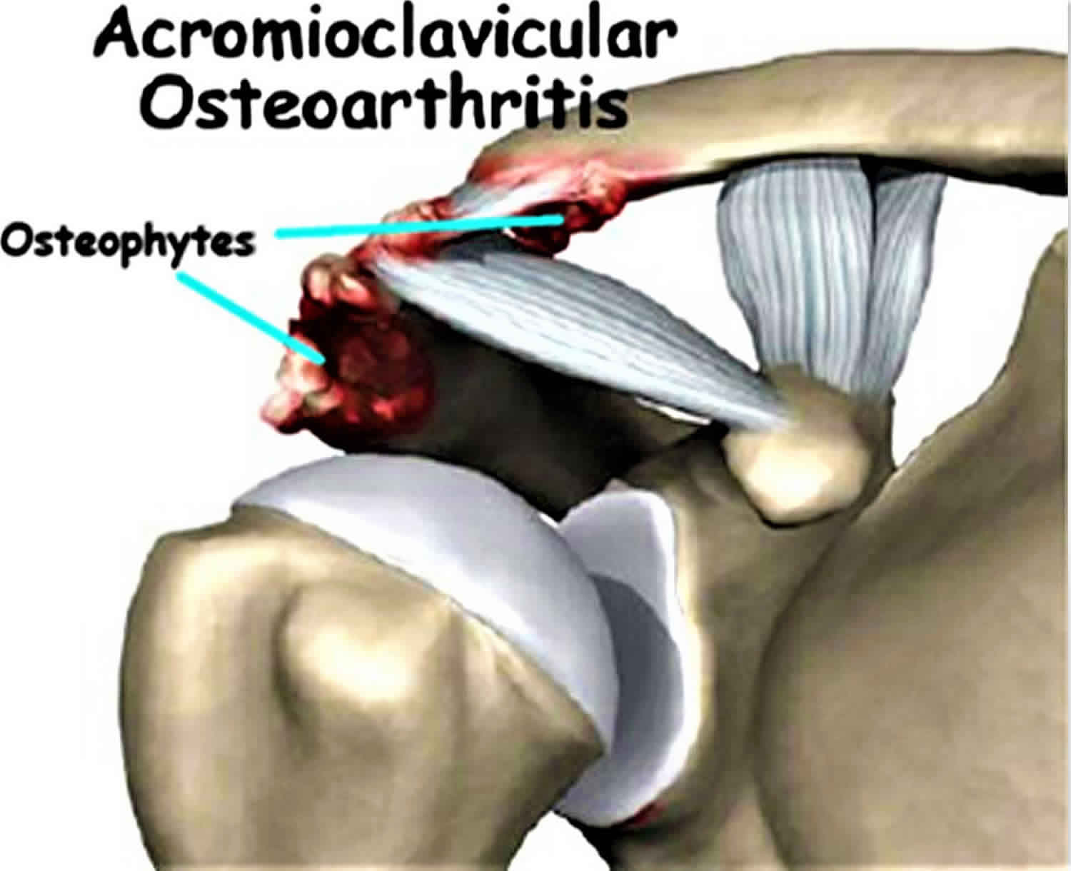 acromioclavicular joint osteoarthritis