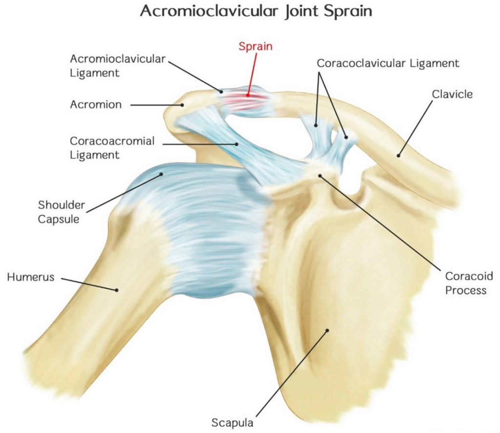 Acromioclaviculargelenkluxation