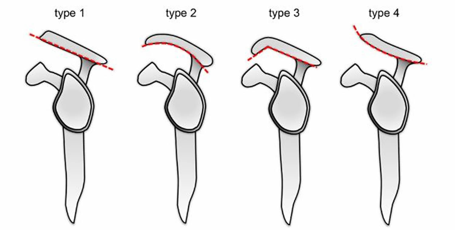 Types Of Acromion Shapes