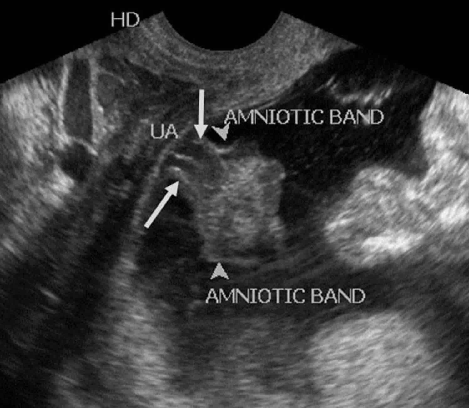 Amniotic band syndrome ultrasound