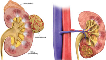 renal angiomyolipoma