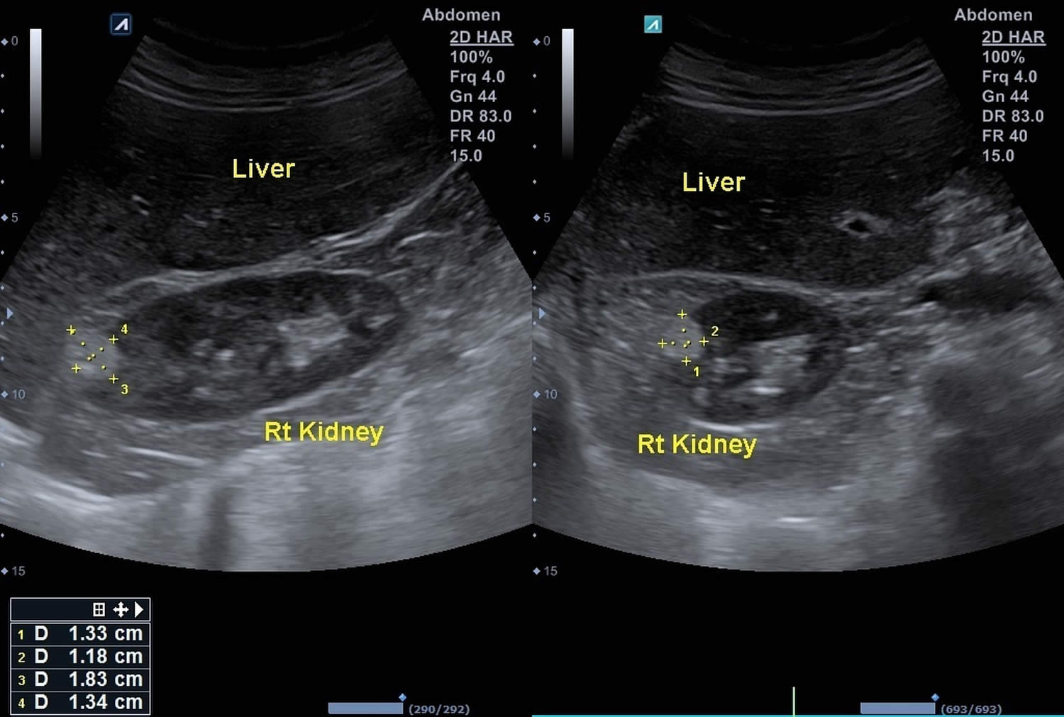 angiomyolipoma ultrasound