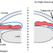 angle closure glaucoma
