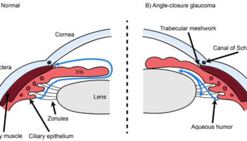 angle closure glaucoma