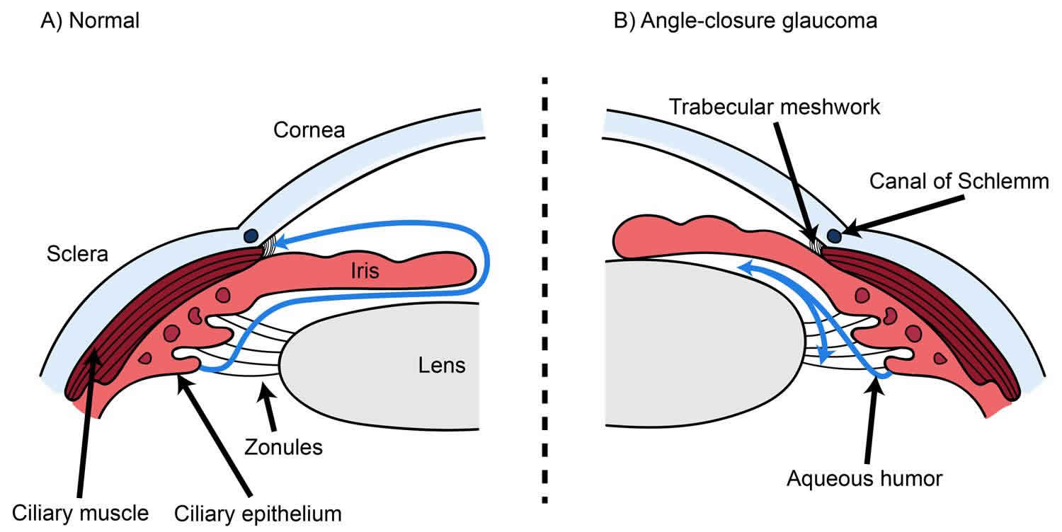 angle closure glaucoma