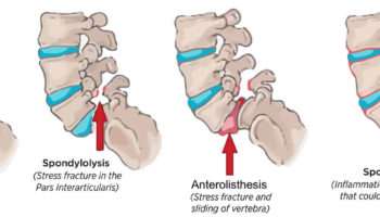 anterolisthesis