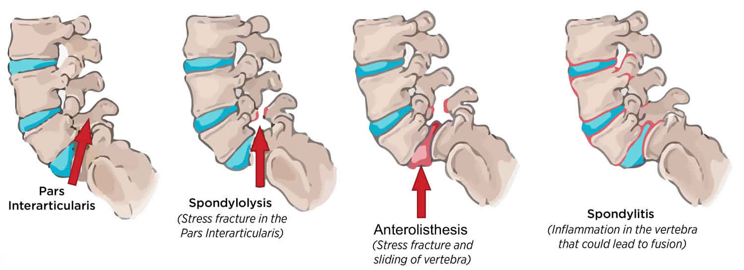 Anterolisthesis 