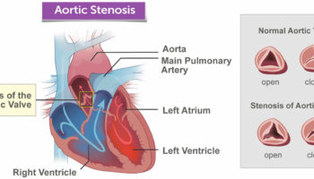 aortic stenosis