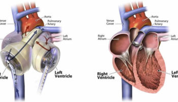 artificial heart