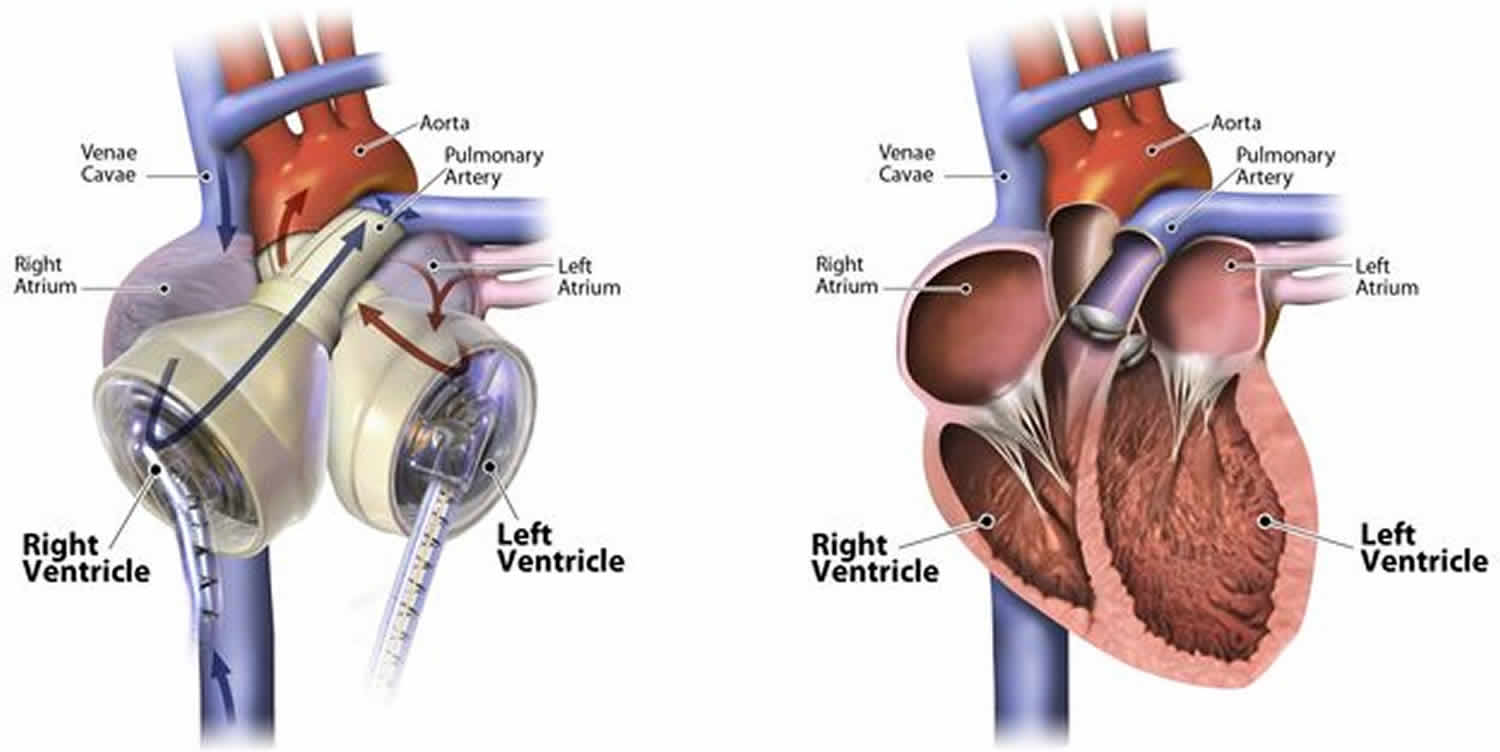 Is It Possible To Make An Artificial Heart