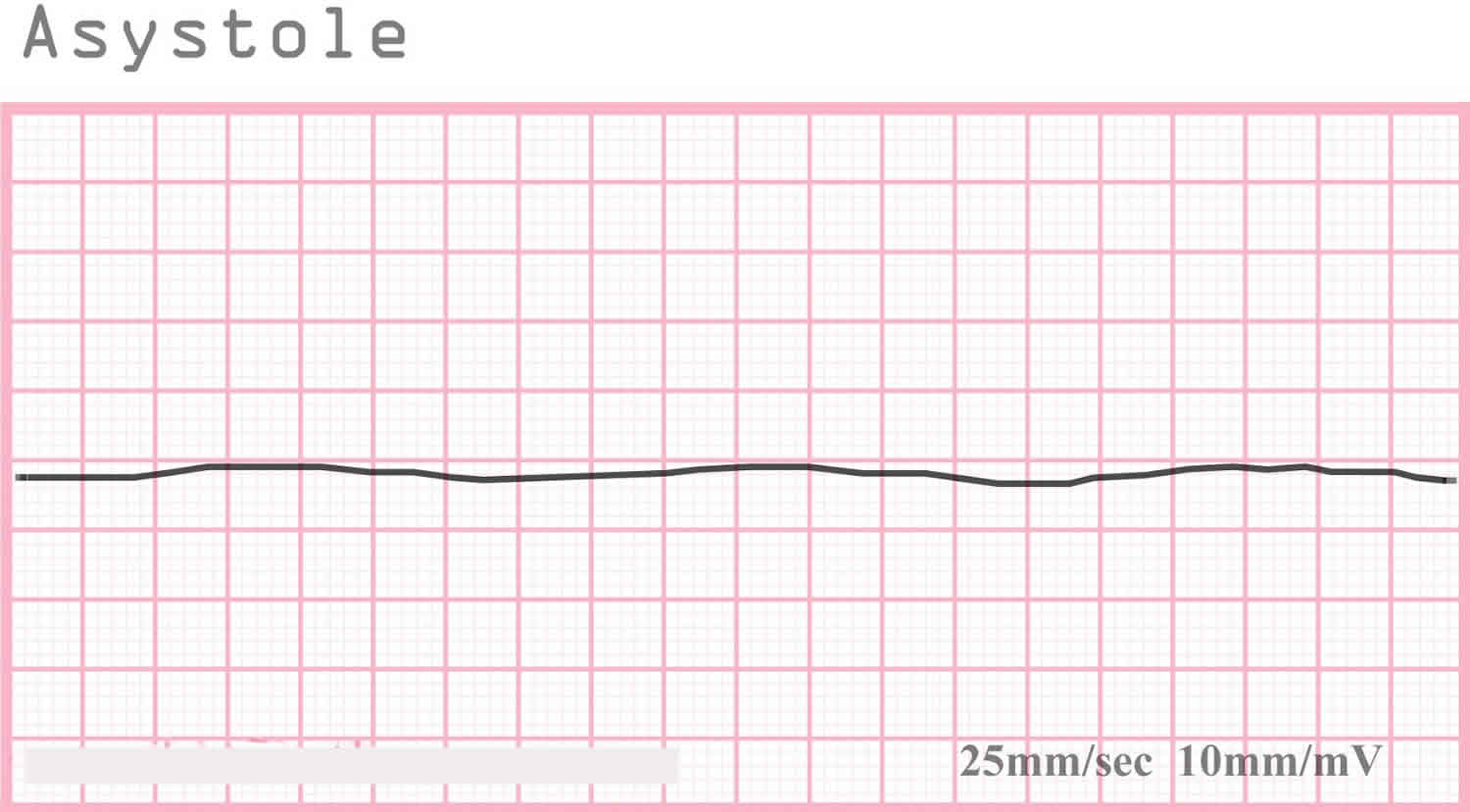 Asystole definition, ECG, EKG & asystole treatment