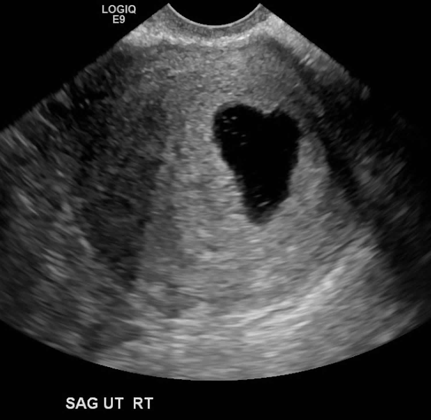 Empty sac tilted uterus ultrasound Misdiagnosed Miscarriage